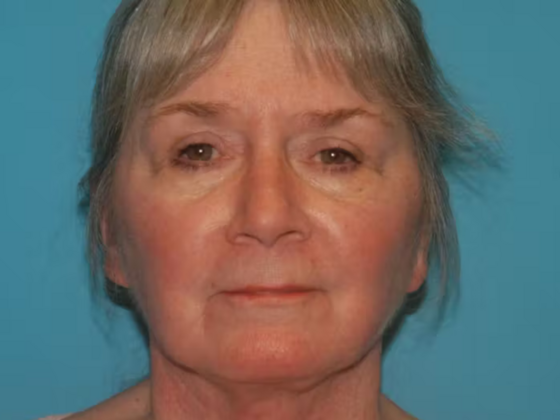 Facelift Case 15 - After