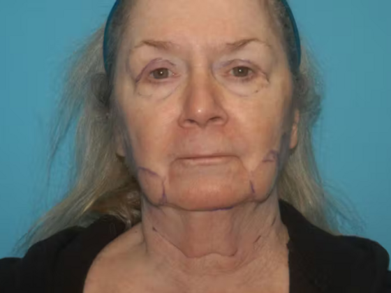 Facelift Case 15 - Before