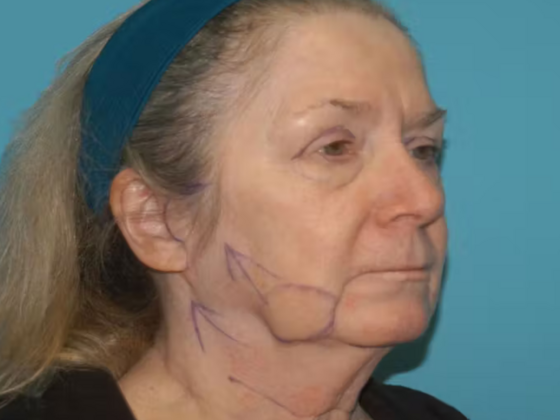 Facelift: Case 15 - Before
