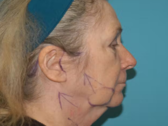 Facelift: Case 15 - Before