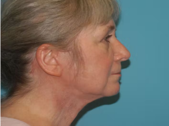 Facelift: Case 15 - After