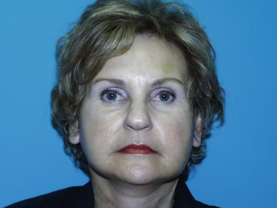 Facelift Case 16 - After