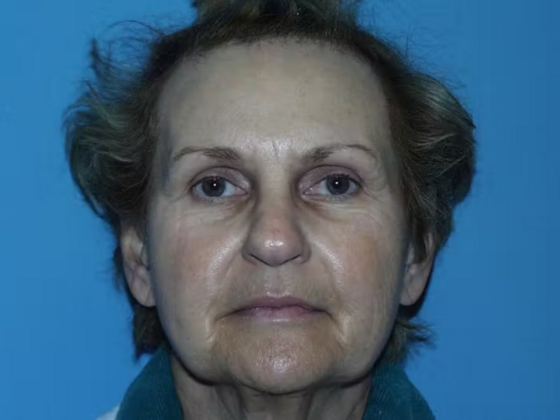 Facelift Case 16 - Before