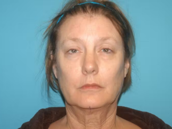 Facelift Case 17 - Before