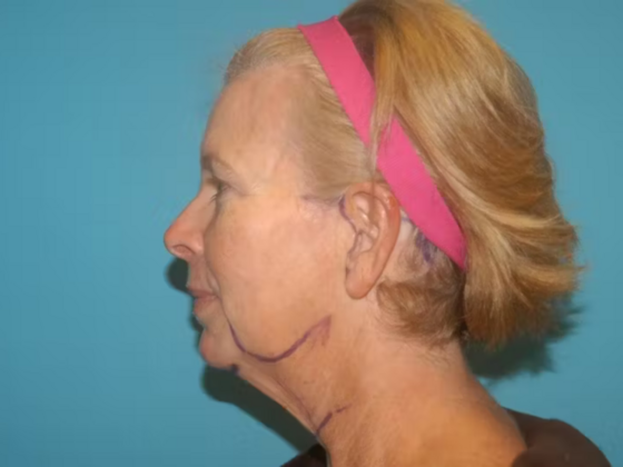 Facelift Case 18 - Before