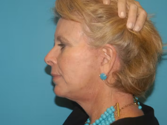 Facelift Case 18 - After