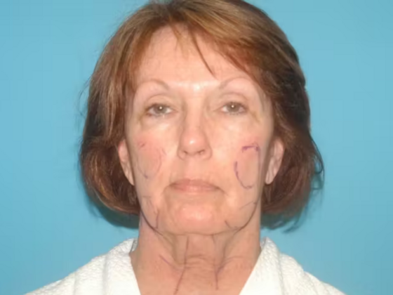 Facelift Case 12 - Before