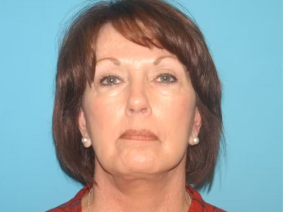 Facelift Case 12 - After