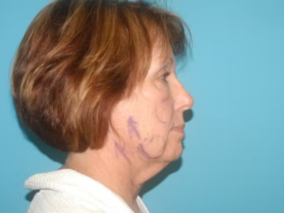 Facelift: Case 12 - Before