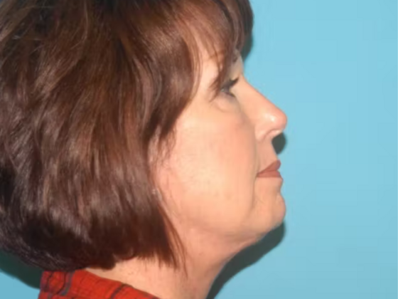 Facelift: Case 12 - After