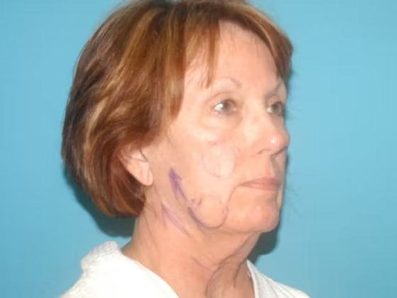 Facelift: Case 12 - Before