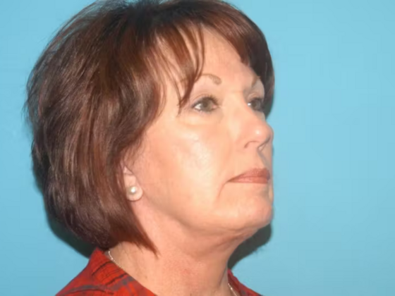 Facelift: Case 12 - After