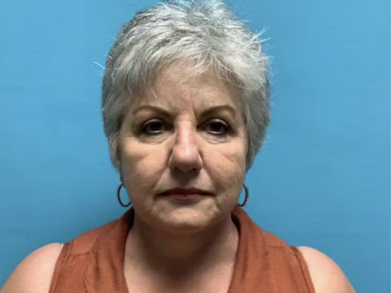 Facelift Case 10 - After