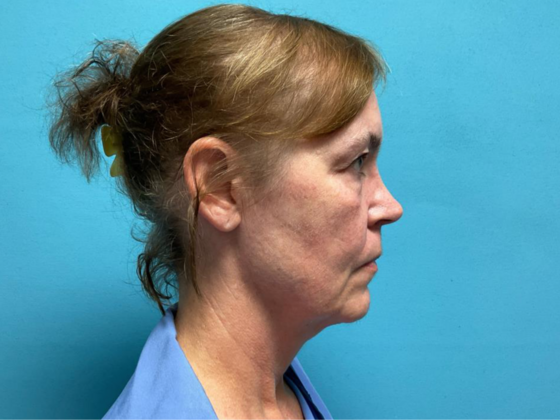 Blepharoplasty: Case 6 - Before