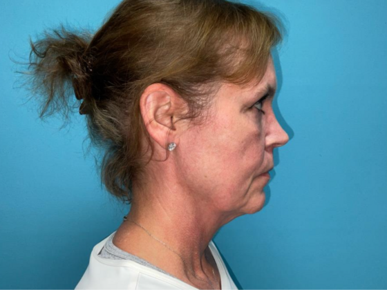 Blepharoplasty: Case 6 - After