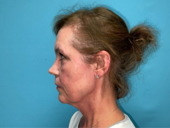 Blepharoplasty: Case 6 - After