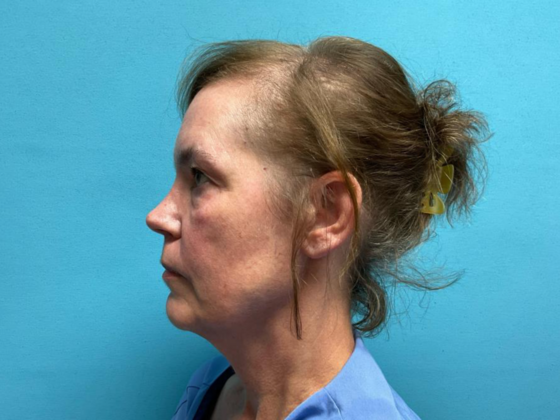 Blepharoplasty: Case 6 - Before