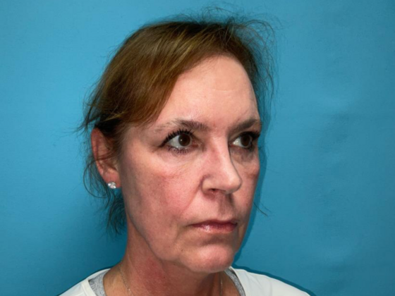 Blepharoplasty: Case 6 - After