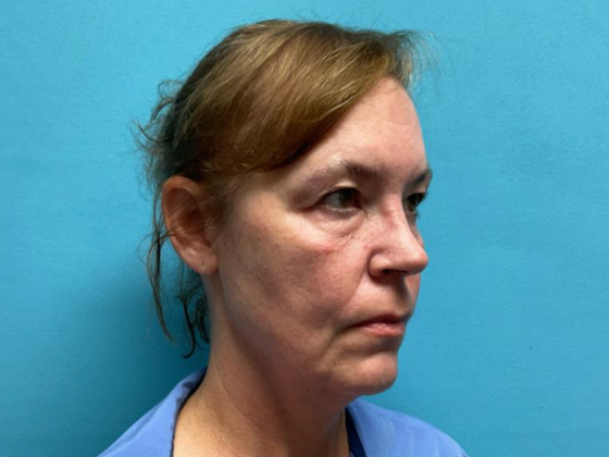 Blepharoplasty: Case 6 - Before