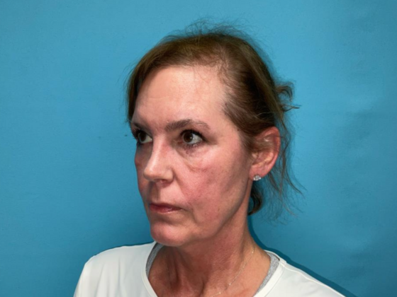 Blepharoplasty: Case 6 - After