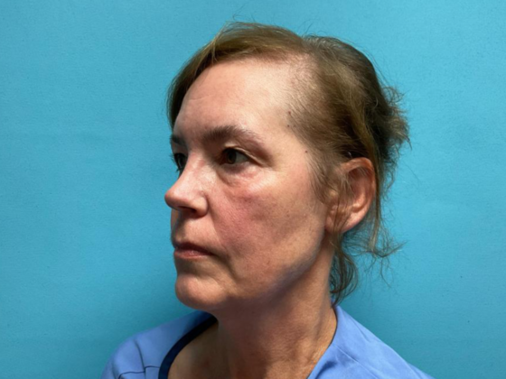Blepharoplasty: Case 6 - Before