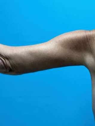 Arm Lift: Case 1 - After