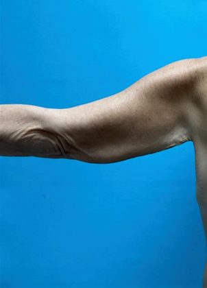 Arm Lift: Case 1 - Before