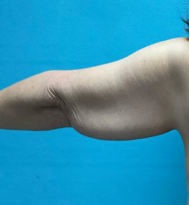 Arm Lift: Case 2 - Before