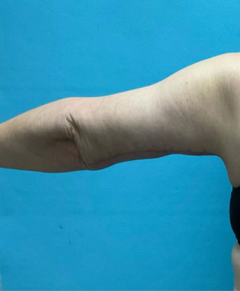 Arm Lift: Case 2 - After