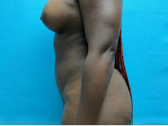 Liposuction: Case 10 - After