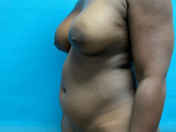 Liposuction: Case 10 - Before