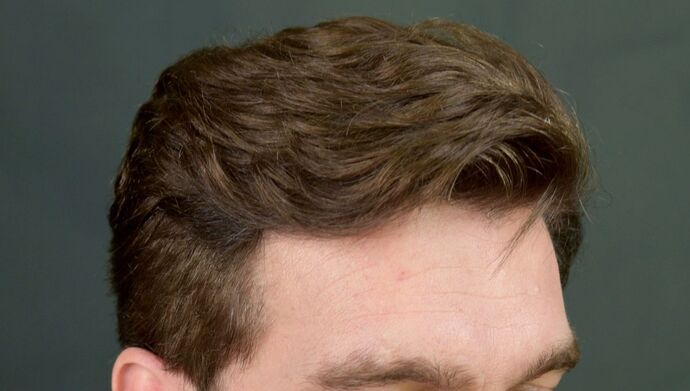 FUT Hair Restoration: Case 17 - After