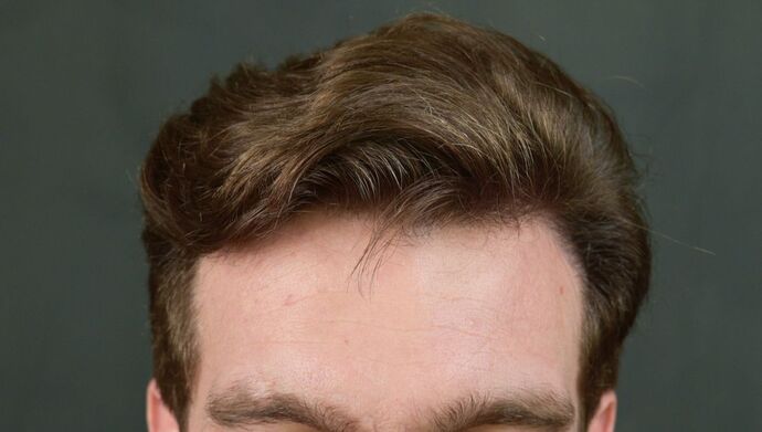 FUT Hair Restoration Case 17 - After