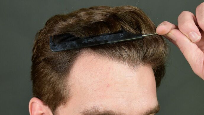 FUT Hair Restoration: Case 17 - After