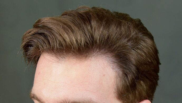 FUT Hair Restoration: Case 17 - After