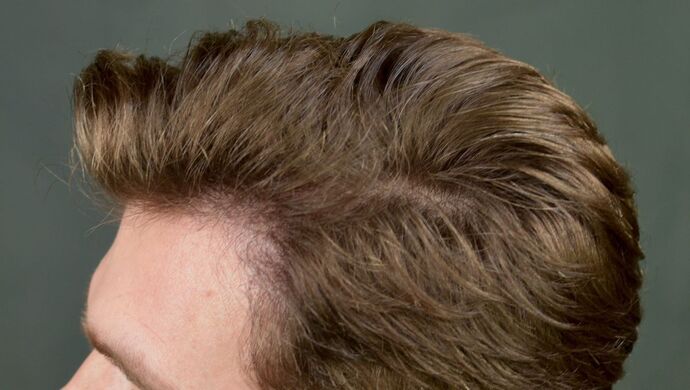 FUT Hair Restoration: Case 17 - After