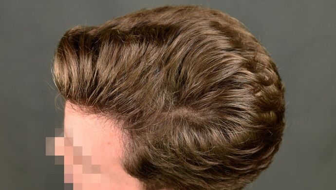 FUT Hair Restoration: Case 17 - After