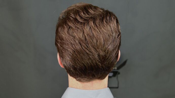 FUT Hair Restoration: Case 17 - After