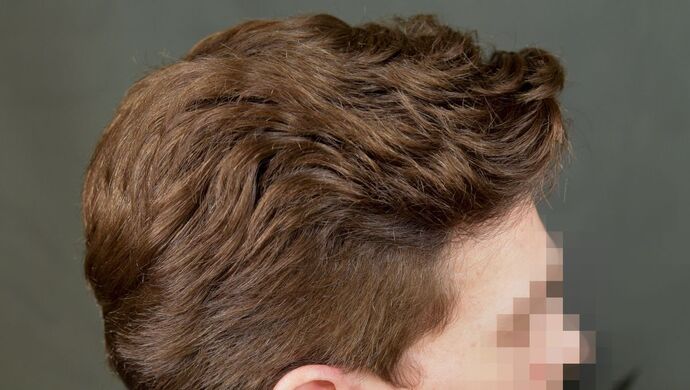 FUT Hair Restoration: Case 17 - After