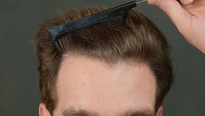 FUT Hair Restoration: Case 17 - After