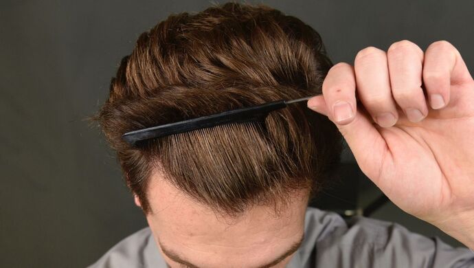 FUT Hair Restoration: Case 17 - After