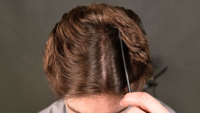 FUT Hair Restoration: Case 17 - After