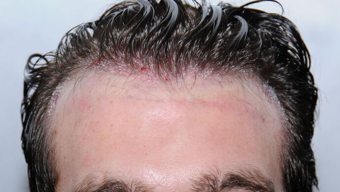 FUT Hair Restoration: Case 17 - Before