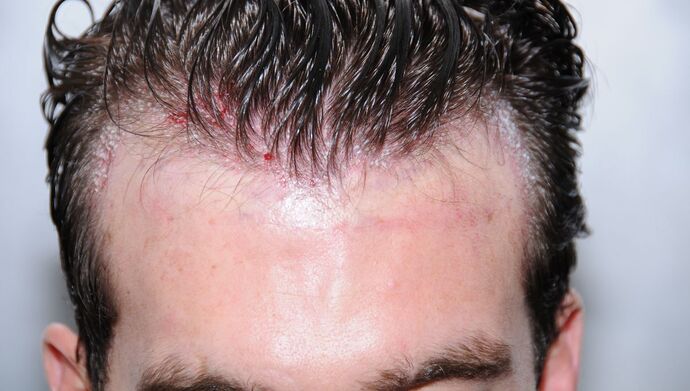 FUT Hair Restoration: Case 17 - Before