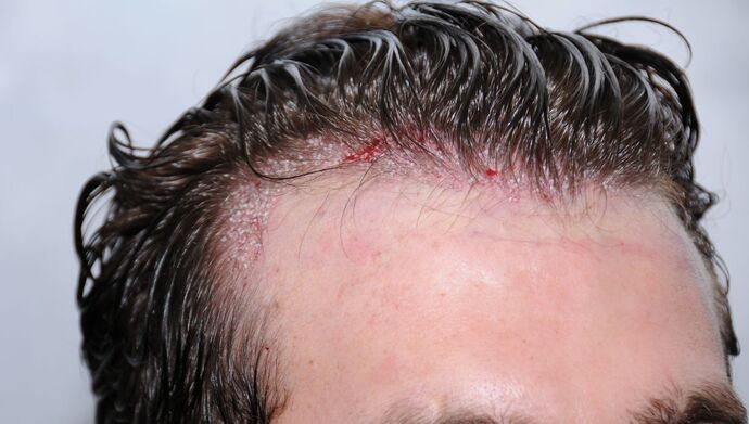 FUT Hair Restoration: Case 17 - Before