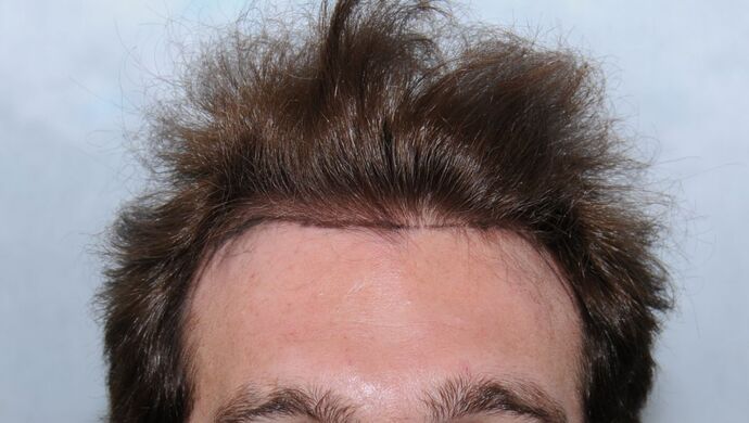 FUT Hair Restoration Case 17 - Before