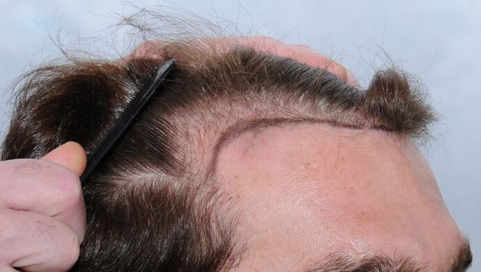 FUT Hair Restoration: Case 17 - Before