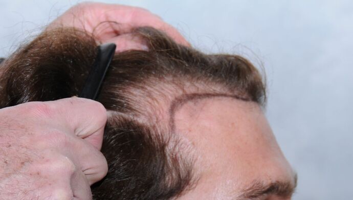 FUT Hair Restoration: Case 17 - Before