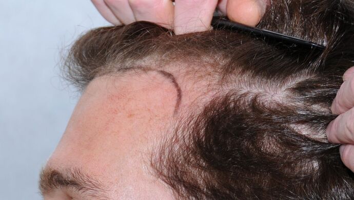 FUT Hair Restoration: Case 17 - Before