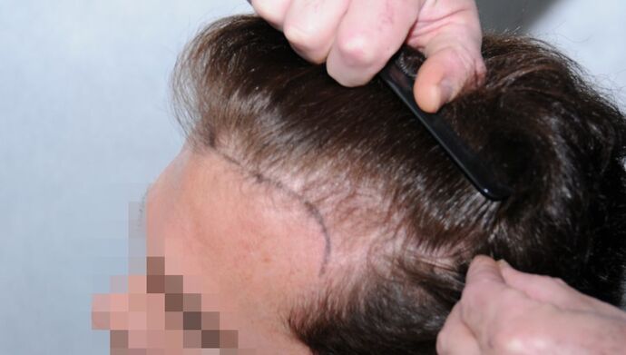 FUT Hair Restoration: Case 17 - Before